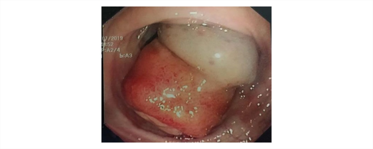 Sheep in Wolfï¿½ï¿½ï¿½s Clothing: Pedunculated Colonic Lipoma with Overlying Hyperplastic and Ulcerated Epithelium