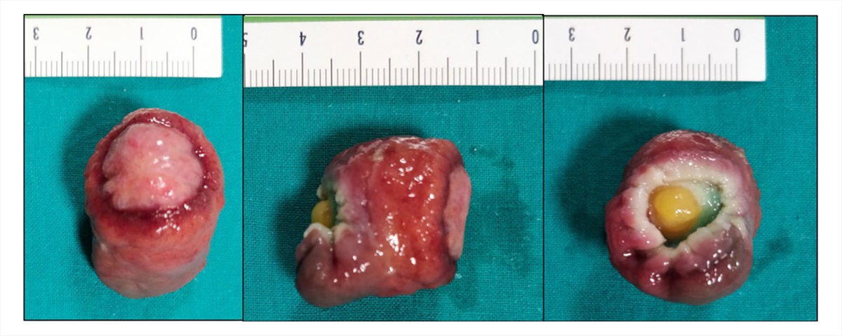 Sheep in Wolfï¿½ï¿½ï¿½s Clothing: Pedunculated Colonic Lipoma with Overlying Hyperplastic and Ulcerated Epithelium