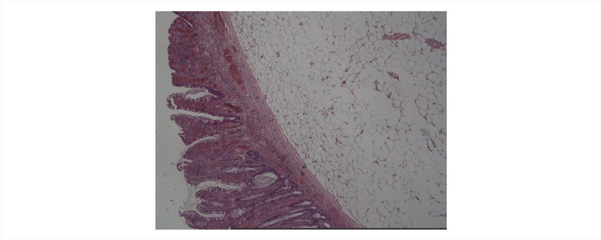 Sheep in Wolfï¿½ï¿½ï¿½s Clothing: Pedunculated Colonic Lipoma with Overlying Hyperplastic and Ulcerated Epithelium