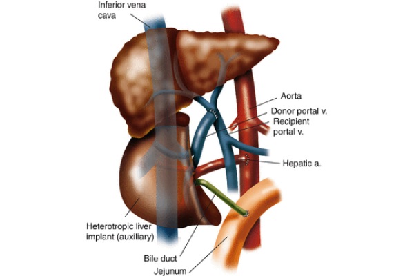 Orthotopic Liver Transplantation: Surgical Techniques