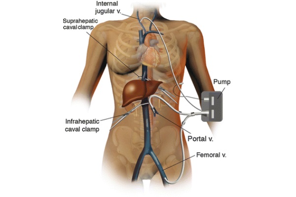 Orthotopic Liver Transplantation: Surgical Techniques