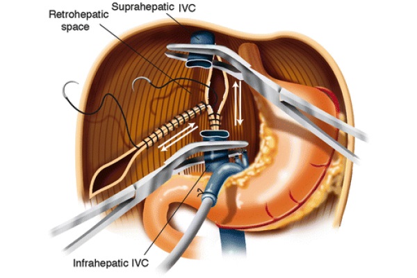 Orthotopic Liver Transplantation: Surgical Techniques