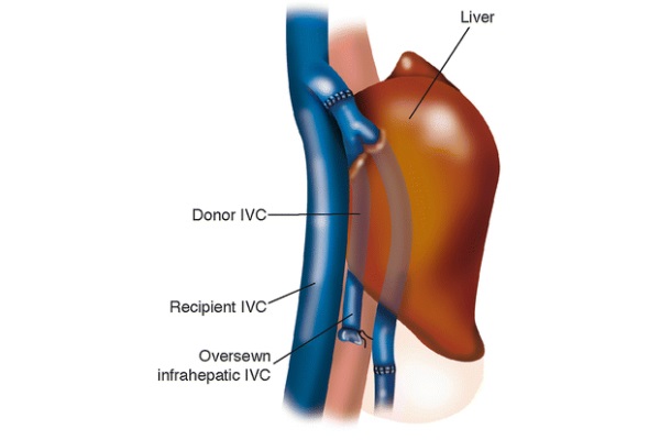 Orthotopic Liver Transplantation: Surgical Techniques