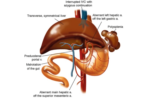 Orthotopic Liver Transplantation: Surgical Techniques