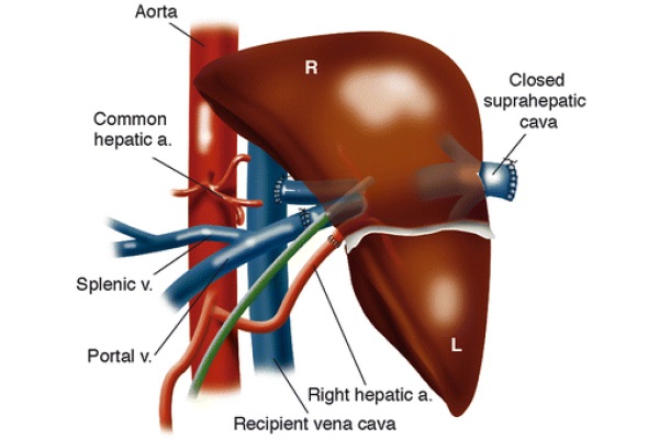 Orthotopic Liver Transplantation: Surgical Techniques